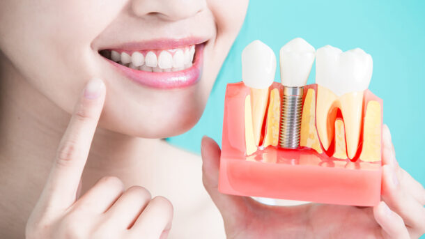 Dental Implants