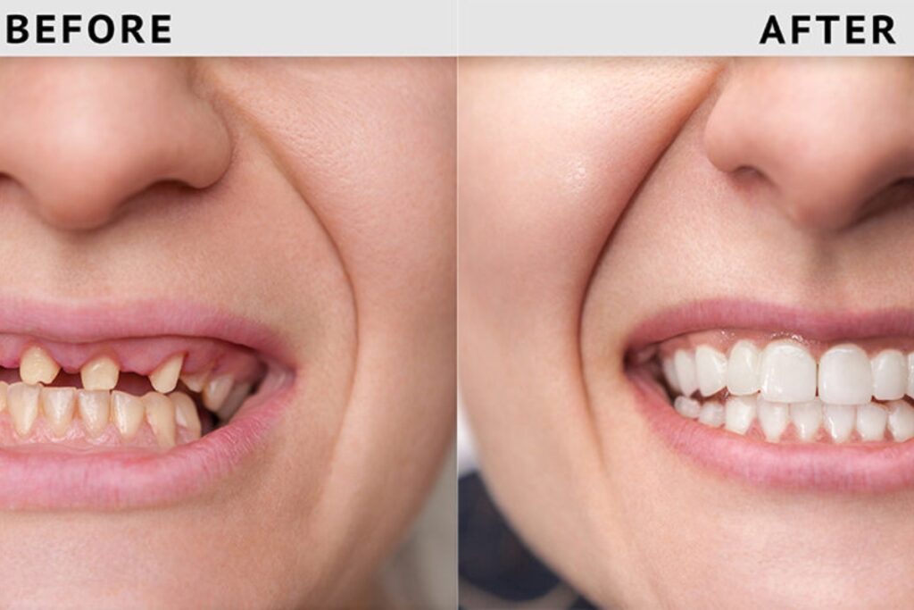 Dental Implants