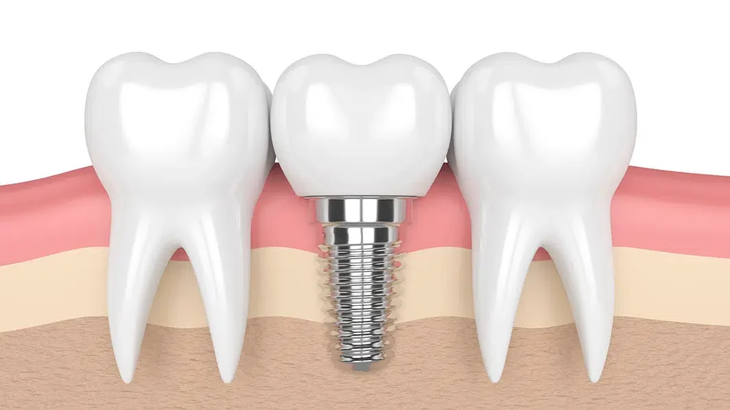 Dental Implants