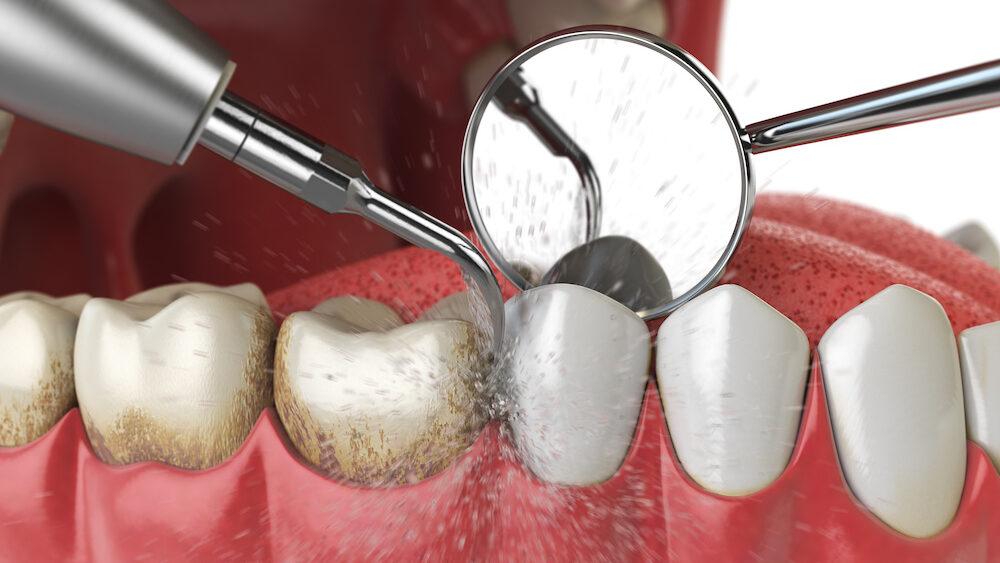 teeth cleaning