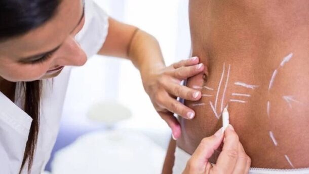 Liposuction