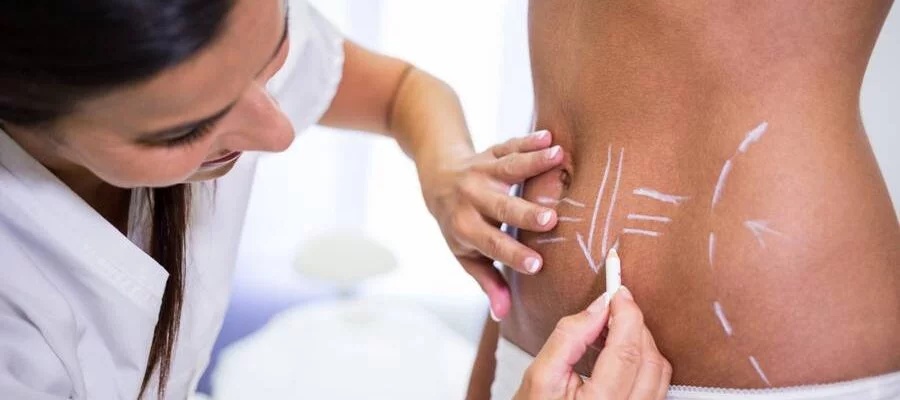 Liposuction Liposuction